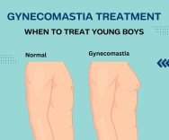 Gynecomastia, When to treat young boys ?