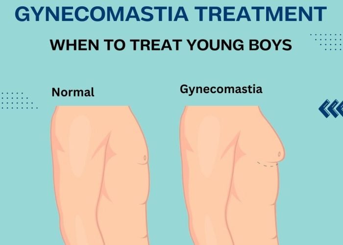 Gynecomastia